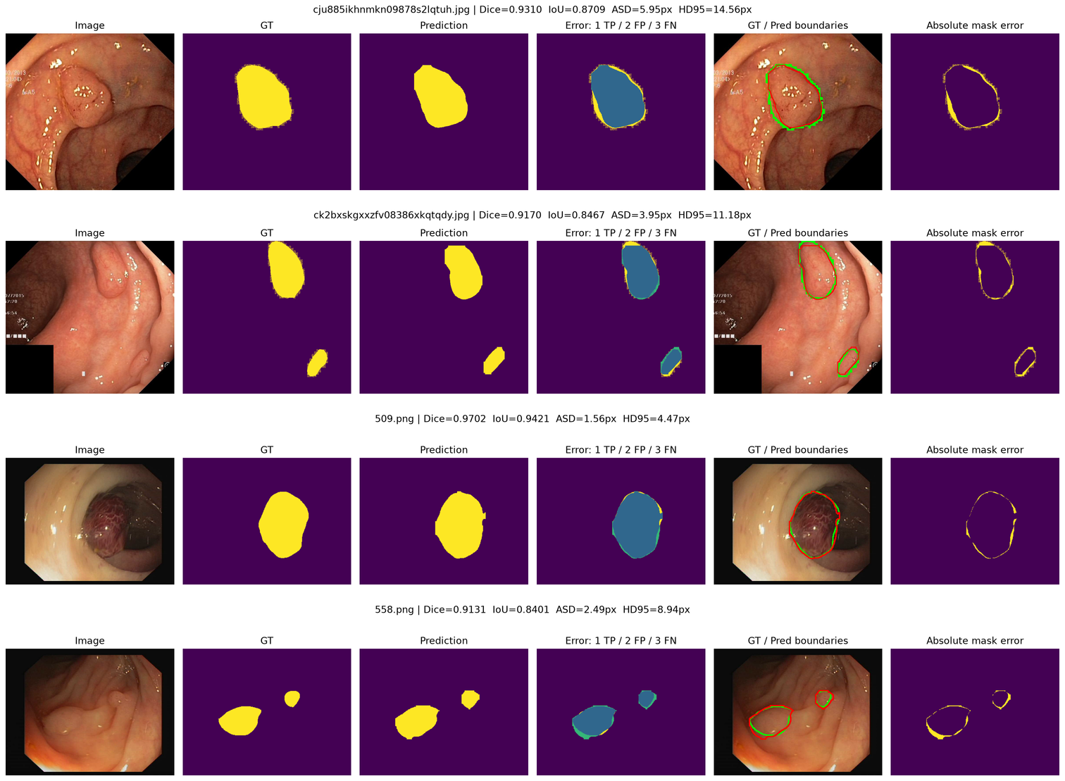 Boundary correction analysis on representative target-domain cases: input image, ground truth, Student prediction, error decomposition, boundary overlay and absolute mask error.