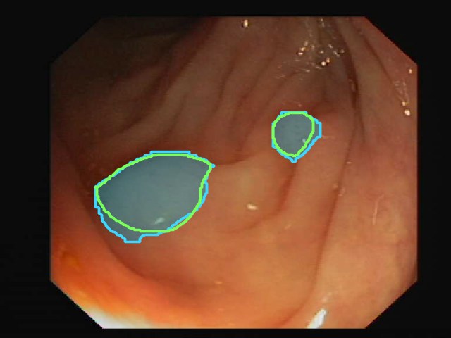 CVC-ClinicDB example: predicted mask and ground-truth contour